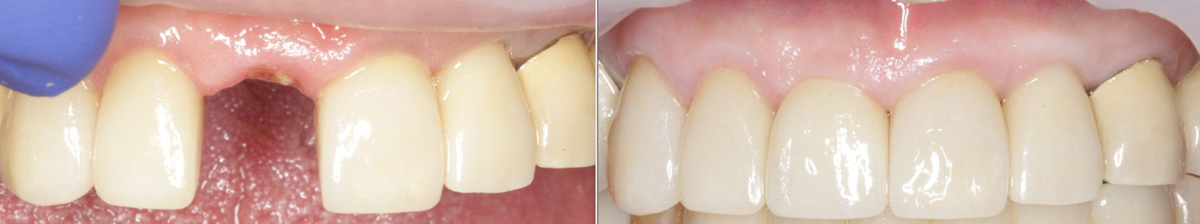 Front tooth implant Esthetic implant dentist Implant specialist IMPrESS Perio Implant Center Dr. M. Noroozi Implant Specialist