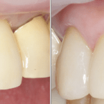 Front tooth implant Esthetic implant dentist Implant specialist IMPrESS Perio Implant Center Dr. M. Noroozi Implant Specialist
