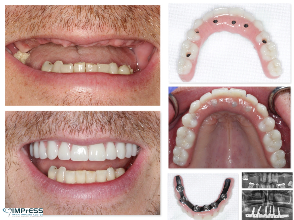 Full Mouth Implant Restoration Burnaby Implant Specialist IMPrESS Perio Implant Center Dr. Noroozi