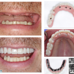 Full Mouth Implant Restoration Burnaby Implant Specialist IMPrESS Perio Implant Center Dr. Noroozi