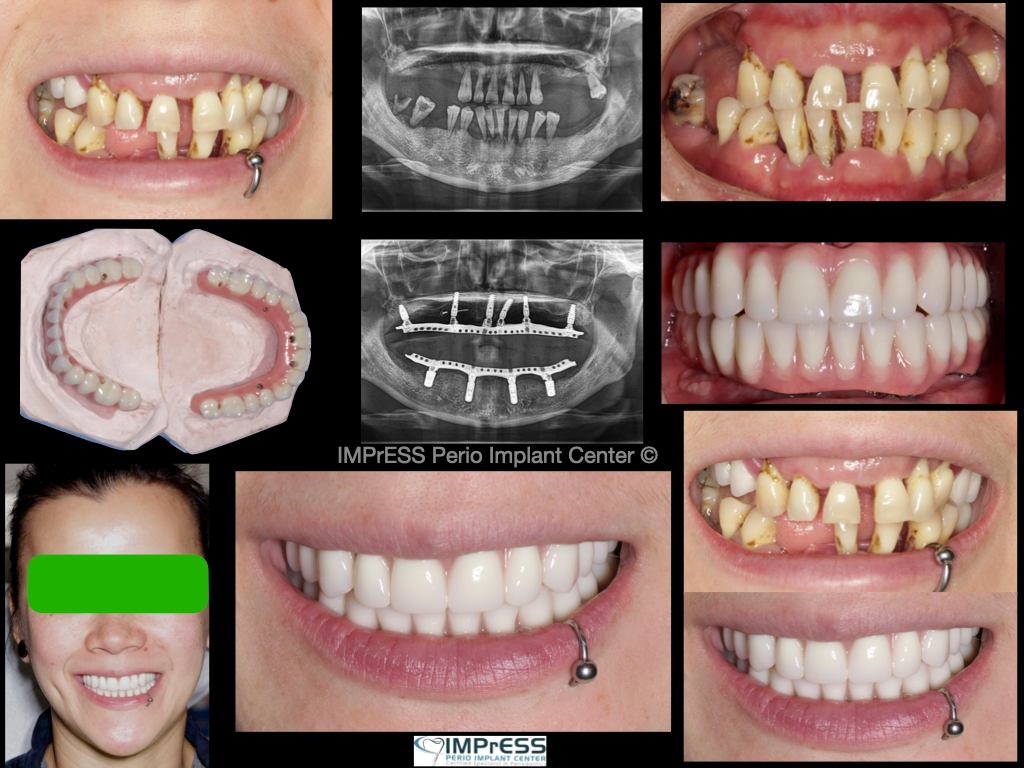 All on 4 Implants Vancouver Burnaby BC IMPrESS Perio Implant Center