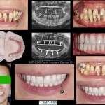 All on 4 Implants Vancouver Burnaby BC IMPrESS Perio Implant Center