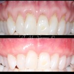 Pinhole Gum Rejuvenation Allograft Dermal Tissue Dr. Noroozi Periodontist IMPrESS Perio Implant Center Vancouver Burnaby BC
