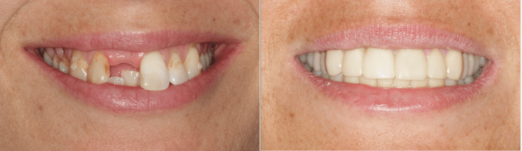 IMPrESS Perio Implant Center Dental Implant Specialized Center Dr Noroozi Vancouver Periodontist