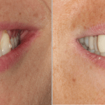 IMPrESS Perio Implant Center Dental Implant Specialized Center Dr Noroozi Vancouver Periodontist