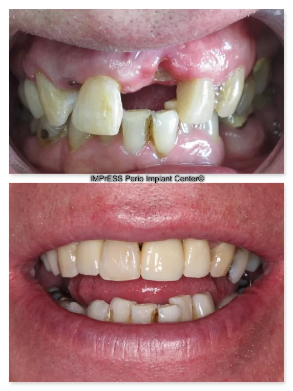 Implants IMPrESS Perio Implant Center Dr. Noroozi Implant Specialist in Vancouver