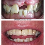 Implants IMPrESS Perio Implant Center Dr. Noroozi Implant Specialist in Vancouver
