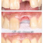 Front Implant Tooth Dr. Mehdi Noroozi IMPrESS Perio Implant Center Vancouver Burnaby Periodontist Implant Specialist