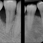 Guided bone and tissue Regeneration emdogain Vancouver IMPrESS Perio Implant Center