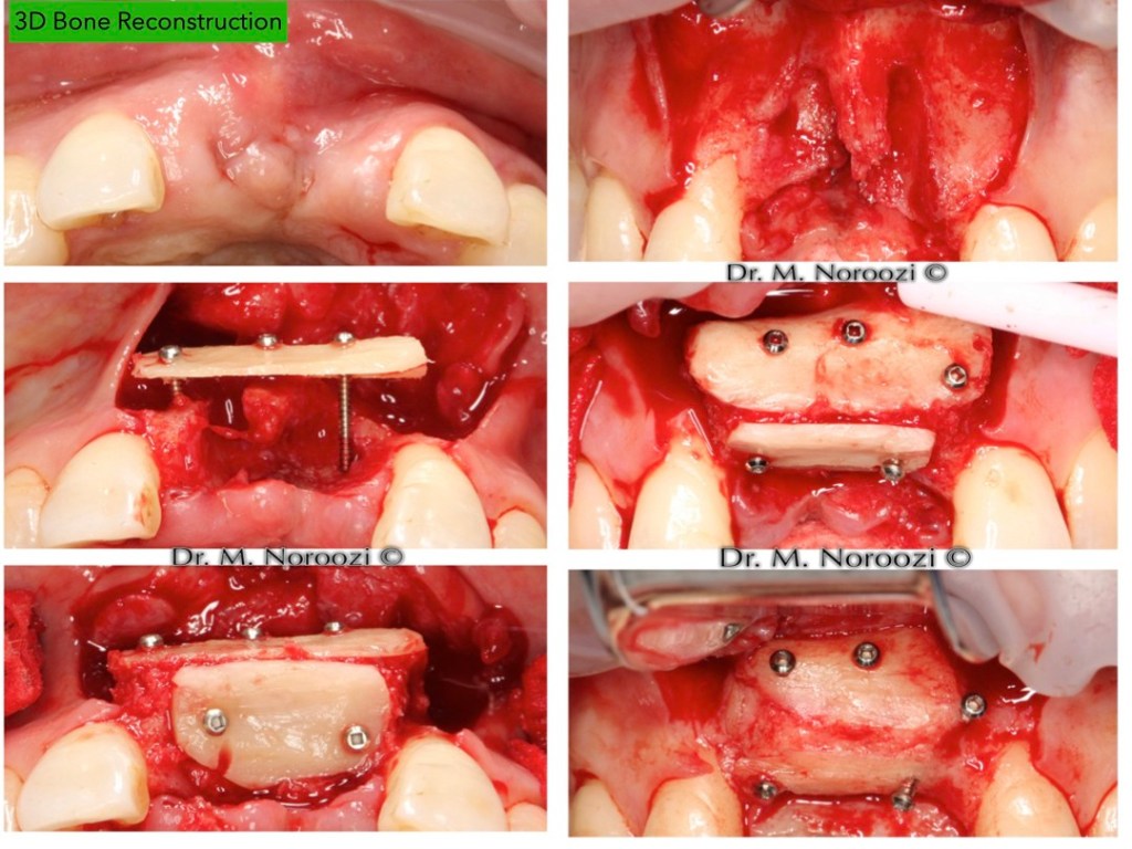 3D-bone-Reconstruction-for-Implants-Dr-Noroozi-Implant-Specialist-in-Burnaby-Vancouver-BC-IMPrESS-Perio-Implant-Cente