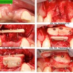 3D-bone-Reconstruction-for-Implants-Dr-Noroozi-Implant-Specialist-in-Burnaby-Vancouver-BC-IMPrESS-Perio-Implant-Cente