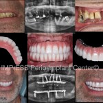 All on X Full Mouth Implant Rehabilitation IMPrESS Perio Implant Center Dr. Noroozi Implant Specialist Burnaby