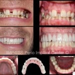 mile Makeover with Full Mouth Implants IMPrESS Perio Implant Center Burnaby BC Dr Noroozi