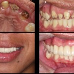 Front Teeth Dental Implant Bridge by Vancouver Dr. Noroozi Implant Specialist