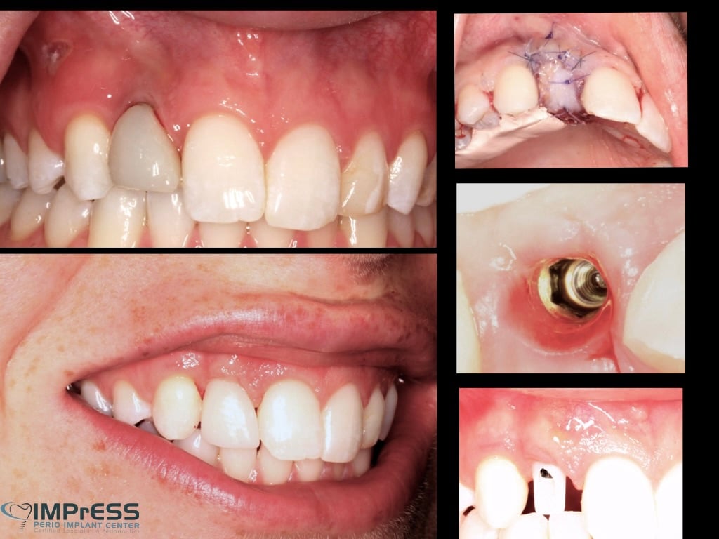 Implant complication management