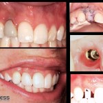 Implant complication management